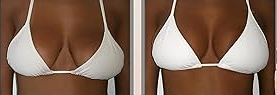 Natural Bust Lift – No Surgery or Padding