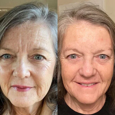 SkinLift Face Tapes